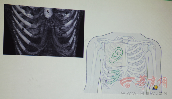 Paciente desarrolla oído en su brazo para posterior trasplante 5